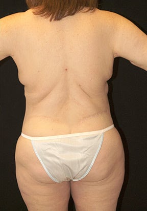 Body Lift 928386