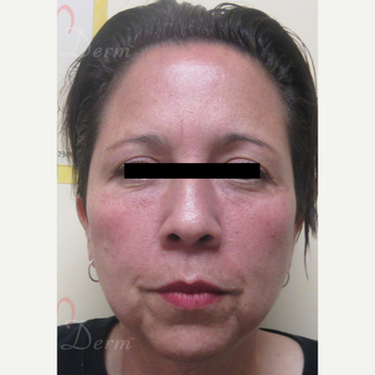 45-54 year old woman treated with Voluma after 3729102