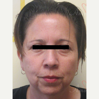 45-54 year old woman treated with Voluma before 3729102