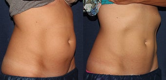 Belly Fat Treatment with CoolSculpting after 1378174