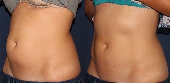 Belly Fat Treatment with CoolSculpting before 1378174