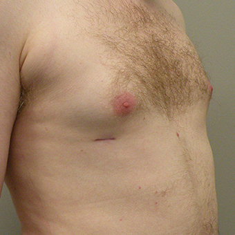 25-34 year old man treated with Male Breast Reduction 2853019