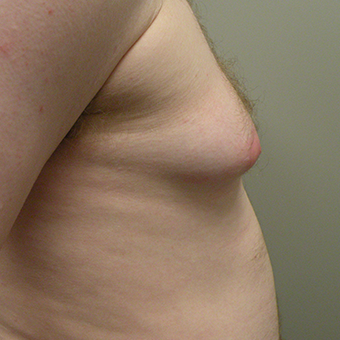 25-34 year old man treated with Male Breast Reduction before 2853019