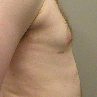 25-34 year old man treated with Male Breast Reduction after 2853019