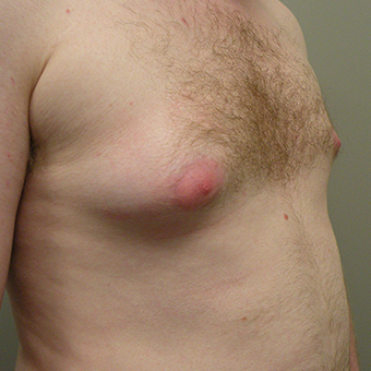 25-34 year old man treated with Male Breast Reduction 2853019