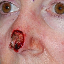 Nasal reconstruction after Mohs surgery before 665295