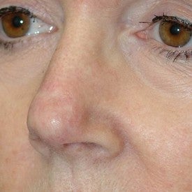 Nasal reconstruction after Mohs surgery after 665295