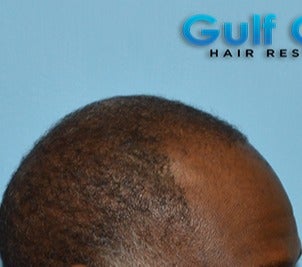 45-54 year old man treated with FUE Hair Transplant before 3624445