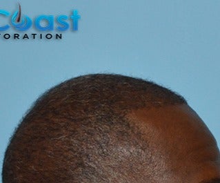 45-54 year old man treated with FUE Hair Transplant after 3624445