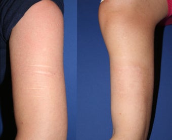 Self-harm scars. Before and after "dermabrasion and thin skin grafting". before 1358436
