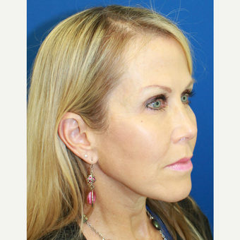 25-34 year old woman treated with Cheek Augmentation after 3741777