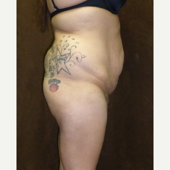 25-34 year old woman treated with Brazilian Butt Lift before 2878396