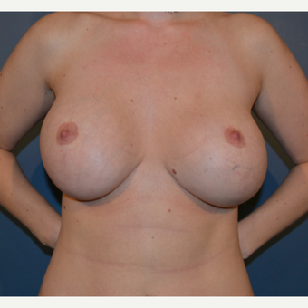 35-44 year old woman treated with Breast Fat Transfer before 3414933