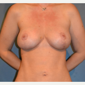35-44 year old woman treated with Breast Fat Transfer after 3414933