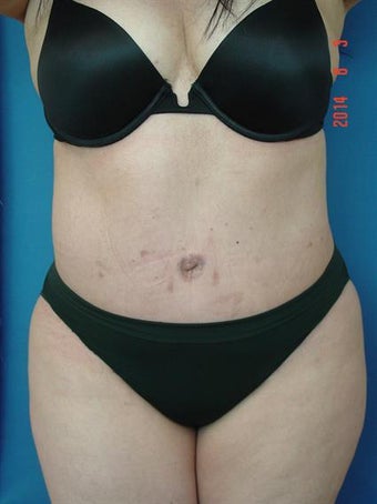 Tummy Tuck- (Extended Abdominoplasty w/Lipo) after 1381311