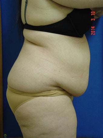 Tummy Tuck- (Extended Abdominoplasty w/Lipo) 1381311
