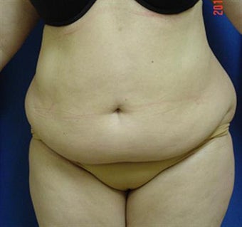 Tummy Tuck- (Extended Abdominoplasty w/Lipo) before 1381311
