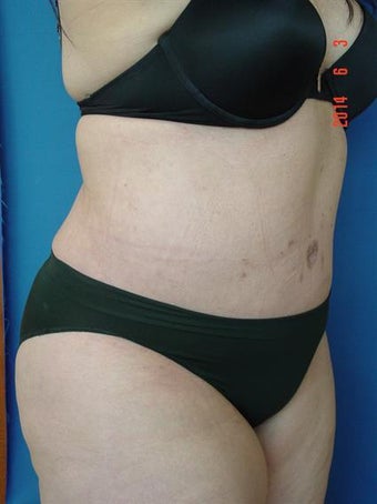 Tummy Tuck- (Extended Abdominoplasty w/Lipo) 1381311