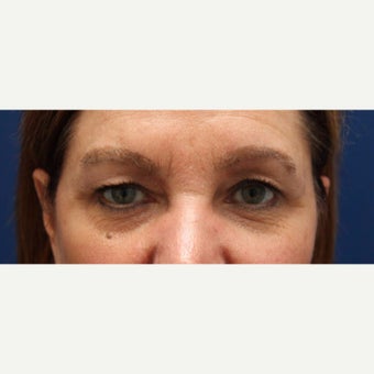 53 year old woman treated with Eyebrow Transplant after 2467801