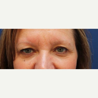 53 year old woman treated with Eyebrow Transplant before 2467801