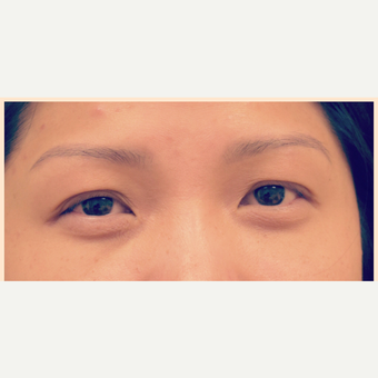 35-44 year old woman treated with Asian Eyelid Surgery before 3305752