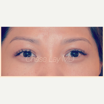 35-44 year old woman treated with Asian Eyelid Surgery after 3305752