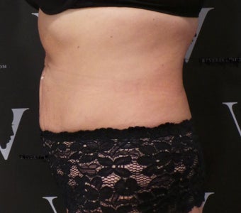 Coolsculpting for a flatter abdomen after 3265270