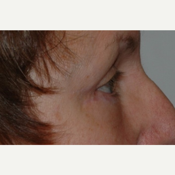 Eyelid Surgery after 3346355