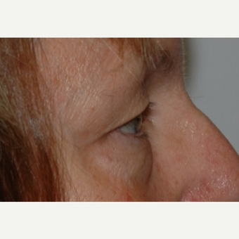 Eyelid Surgery before 3346355