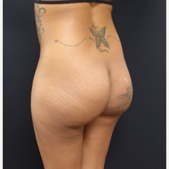 25-34 year old woman treated with Fat Transfer and Butt Implants for her Butt Lift before 3129332