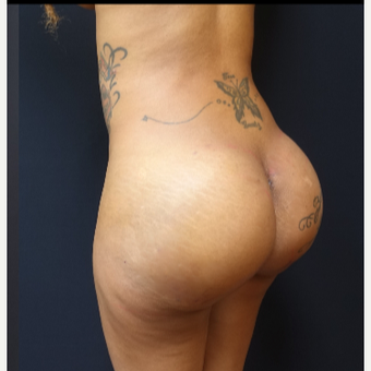 25-34 year old woman treated with Fat Transfer and Butt Implants for her Butt Lift after 3129332