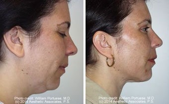 Liposuction of neck and double chin before 6812