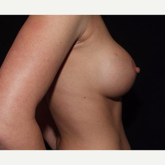 25-34 year old woman treated with Breast Implants after 3593573