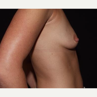 25-34 year old woman treated with Breast Implants before 3593573