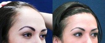 Forehead Reduction Surgery or Hairline Lowering Surgery 323754