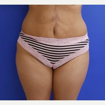 35-40 year old woman treated with Tummy Tuck, Scar Revision and Flank Liposuction before 2011987