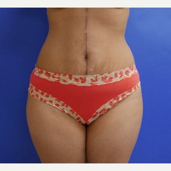 35-40 year old woman treated with Tummy Tuck, Scar Revision and Flank Liposuction after 2011987