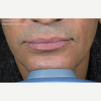 Non Surgical Jaw Enhancement before 2972593