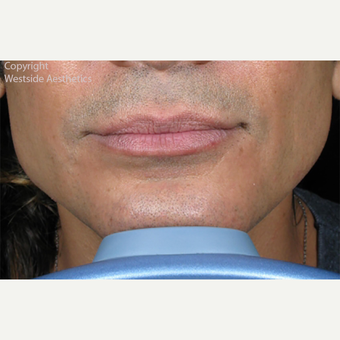 Non Surgical Jaw Enhancement after 2972593