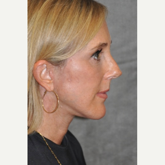 45-54 year old woman treated with Facelift after 3567151
