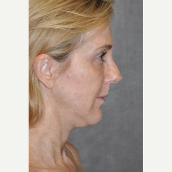 45-54 year old woman treated with Facelift before 3567151