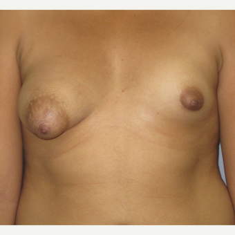 18-24 year old woman treated with Breast Augmentation before 3503069