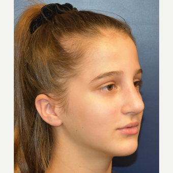 17 or under year old woman treated with Rhinoplasty after 3306023