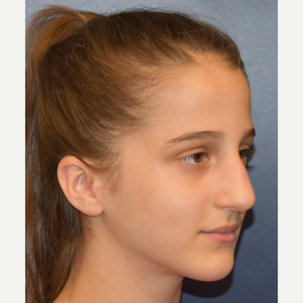17 or under year old woman treated with Rhinoplasty before 3306023