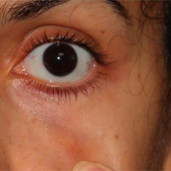 28 year old woman for large blue veins under her eyes after 3124163
