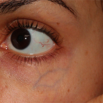 28 year old woman for large blue veins under her eyes before 3124163