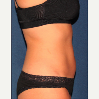 25-34 year old woman treated with Liposculpture after 3137054