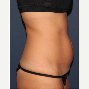 25-34 year old woman treated with Liposculpture before 3137054