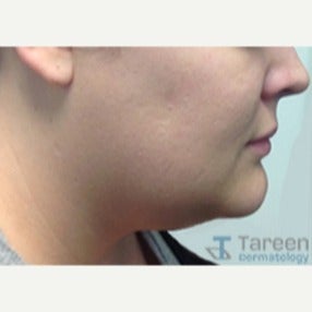 29 year old woman treated with CoolSculpting CoolMini applicator after 2504960
