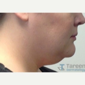 29 year old woman treated with CoolSculpting CoolMini applicator before 2504960